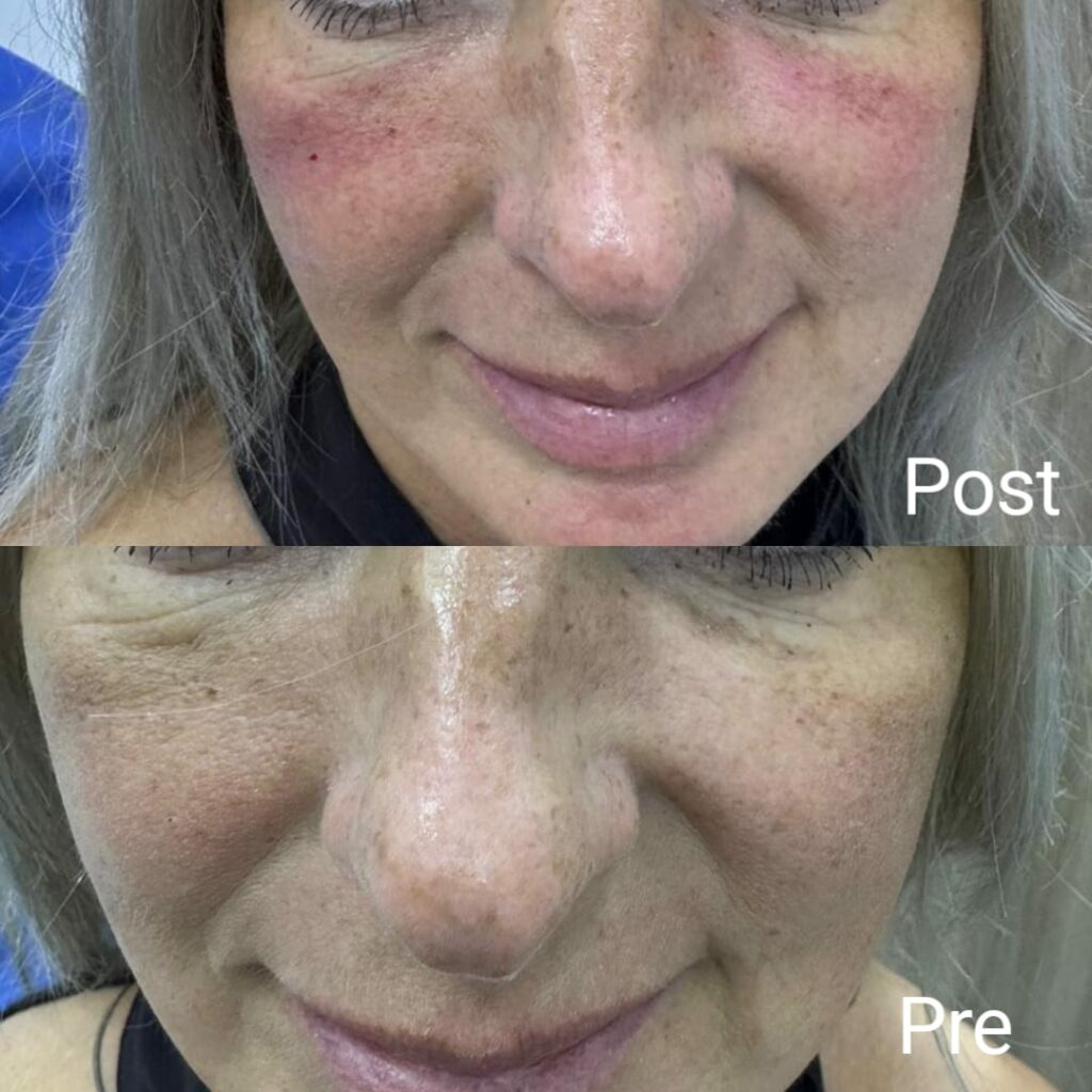 جلسة فيلر قبل وبعد